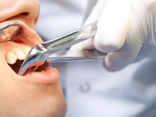 Dịch vụ nhổ răng khôn an toàn – Không đau tại Nha Khoa Hiếu Thuận