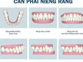 Niềng răng thẩm mỹ – Giải pháp mang lại nụ cười đẹp hoàn hảo