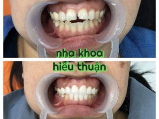 Bọc răng sứ - Kiến tạo nụ cười tự nhiên, an toàn, bền đẹp lâu dài