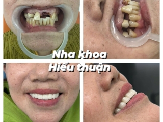 Phục Hình Răng Thẩm Mỹ – Giải Pháp Hoàn Hảo Cho Nụ Cười Tự Tin Tại Nha Khoa Hiếu Thuận