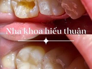 Trám Răng Thẩm Mỹ – Giải Pháp Phục Hồi Răng Sâu, Sứt Mẻ Hiệu Quả Tại Nha Khoa Hiếu Thuận