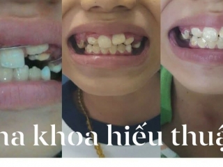CHỈNH NHA BẰNG KHÍ CỤ CHO TRẺ EM – GIẢI PHÁP “VÀNG” CHO NỤ CƯỜI TƯƠNG LAI