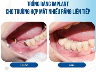 CẤY GHÉP IMPLANT CÓ THỂ ÁP DỤNG CHO MỌI TRƯỜNG HỢP MẤT RĂNG