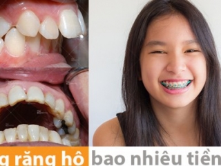 Tại Sao Nên Niềng Răng? Lợi Ích, Quy Trình Và Tất Cả Những Điều Bạn Cần Biết