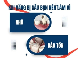 KHI RĂNG BỊ SÂU NÊN LÀM GÌ? NHỔ HAY BẢO TỒN?