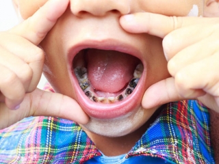 Khám răng định kỳ cho trẻ em – Giải pháp ngăn ngừa sâu răng hiệu quả từ sớm