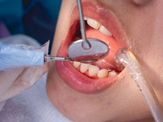 Lấy Cao Răng – Làm Sạch Mảng Bám Bảo Vệ Nướu Khỏe Mạnh