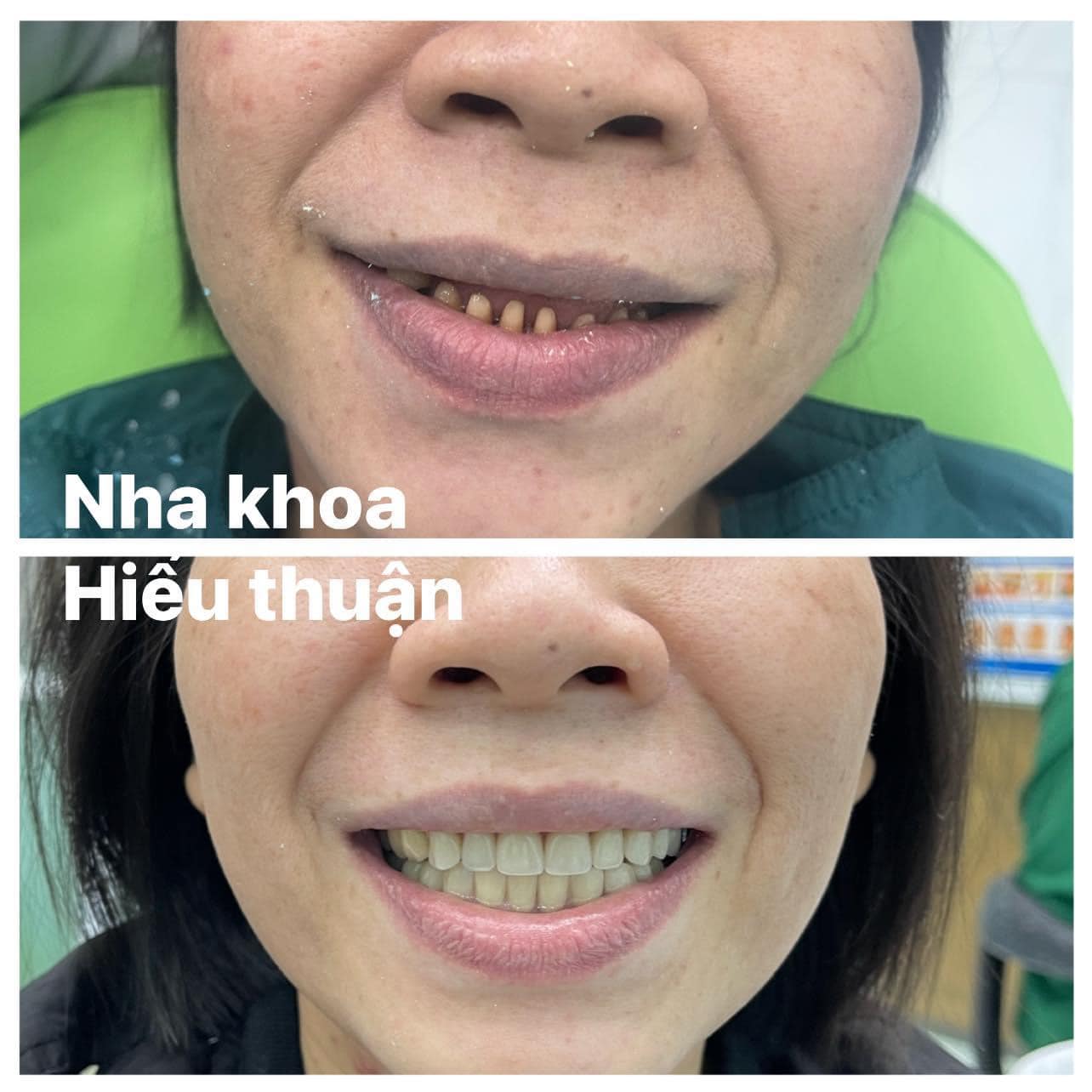 TRỒNG RĂNG: GIẢI PHÁP PHỤC HỒI RĂNG HOÀN HẢO TẠI NHA KHOA HIẾU THUẬN