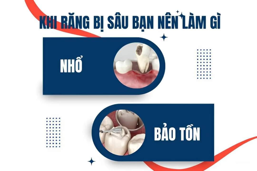 NHỔ RĂNG SÂU: GIẢI PHÁP LOẠI BỎ RĂNG BỊ HỦY TỔN, BẢO VỆ SỨC KHỎE RĂNG MIỆNG