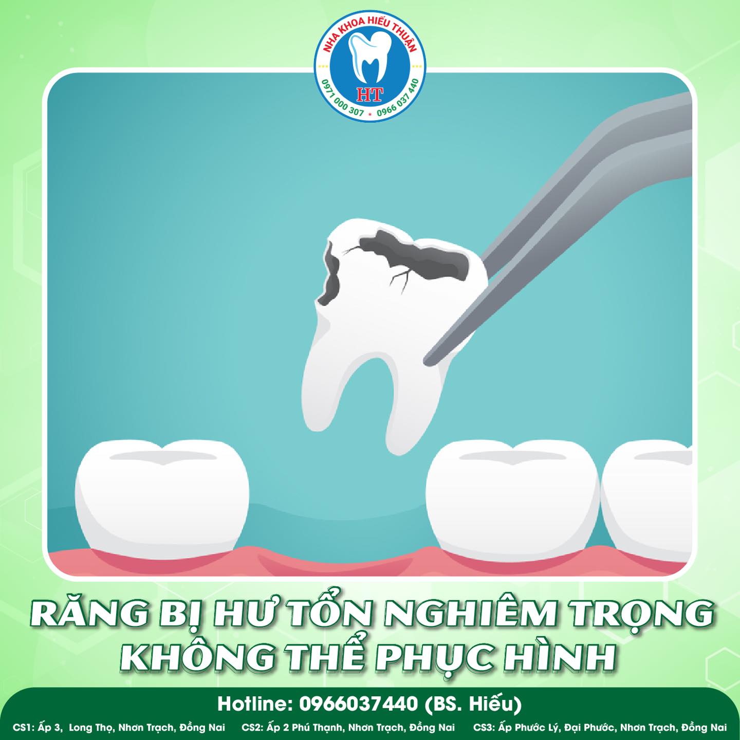 NHỔ RĂNG SÂU: GIẢI PHÁP LOẠI BỎ RĂNG BỊ HỦY TỔN, BẢO VỆ SỨC KHỎE RĂNG MIỆNG