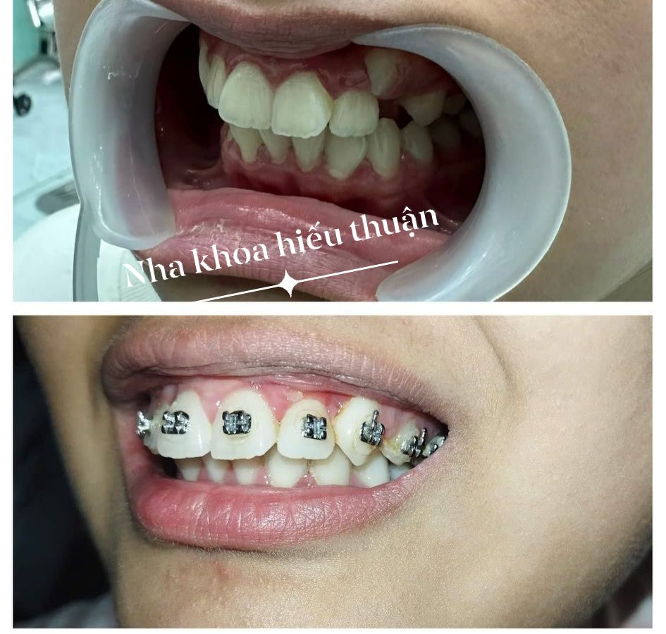 NIỀNG RĂNG - GIẢI PHÁP TOÀN DIỆN CHO NỤ CƯỜI TỰ TIN