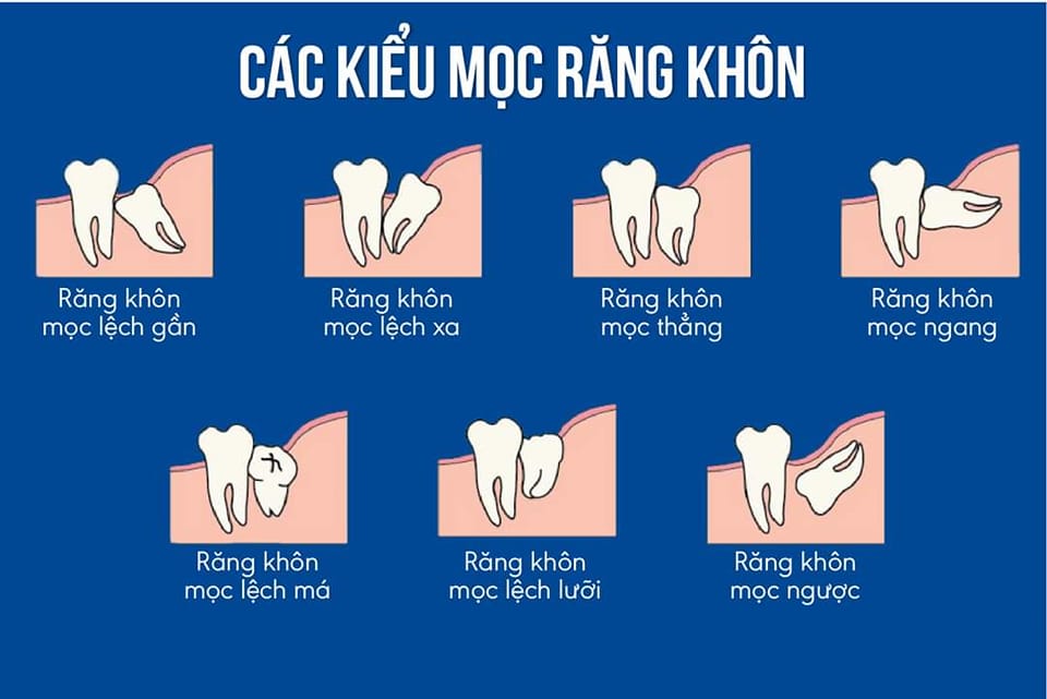 RĂNG KHÔN: “KHÔN” CHƯA CHẮC ĐÃ LÀNH!