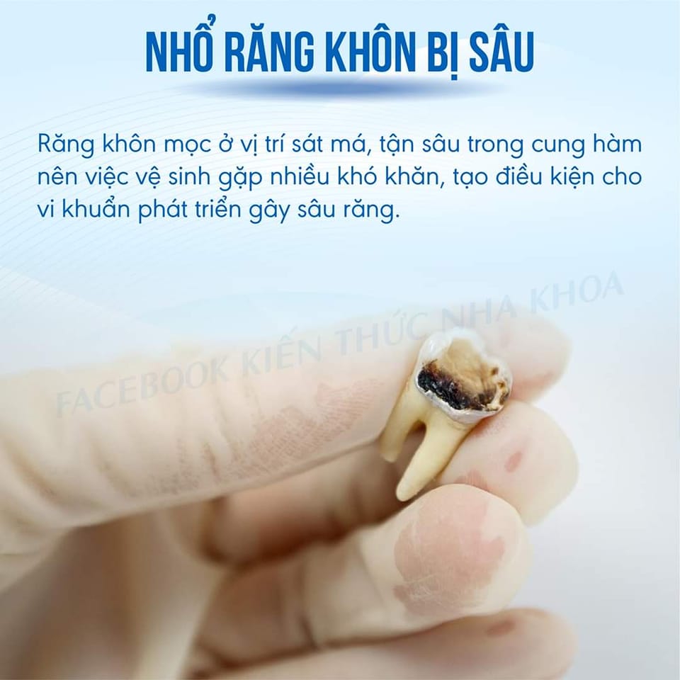 RĂNG KHÔN: “KHÔN” CHƯA CHẮC ĐÃ LÀNH!